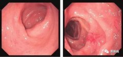 萎縮性胃炎不可怕，只要