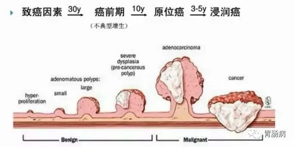 體檢查出腸息肉一定要切除！ 95%腸癌由它演變而來