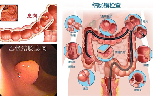 南寧肛瘺療法哪一種好