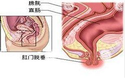 南寧治療脫肛哪家醫(yī)院好？南寧脫肛治療多少錢？